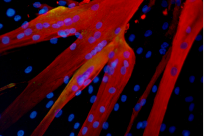 muscular dystrophy